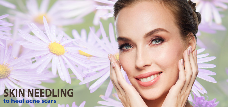 Skin Needling to Heal Acne Scars and Other Common Skin Problems