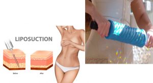 Liposuction or Liposphere Therapy?